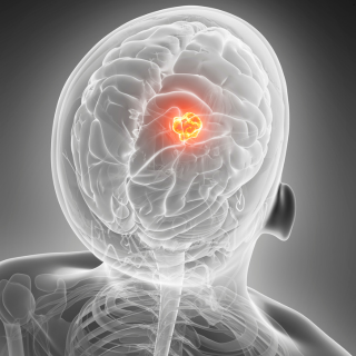 2025 EDW Multidisciplinary Neuro Oncology Tumor Board (RSS) Banner